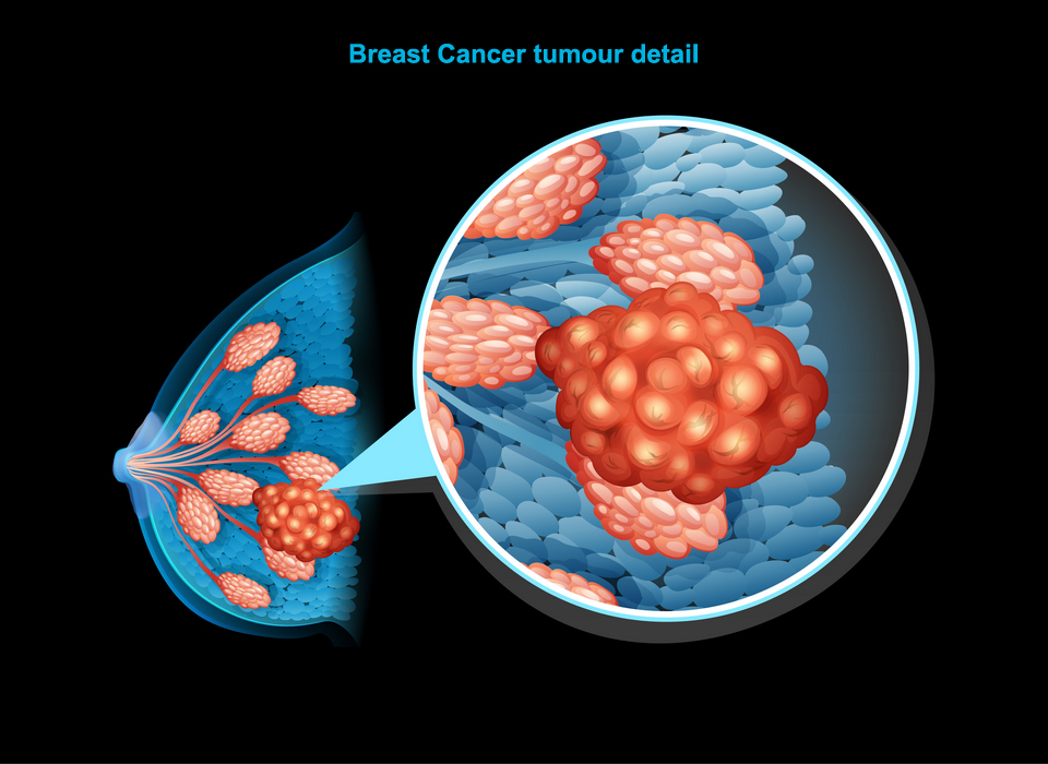 Breast Cancer Tumor Detail Large, Breast Cancer, Ashray Mylan