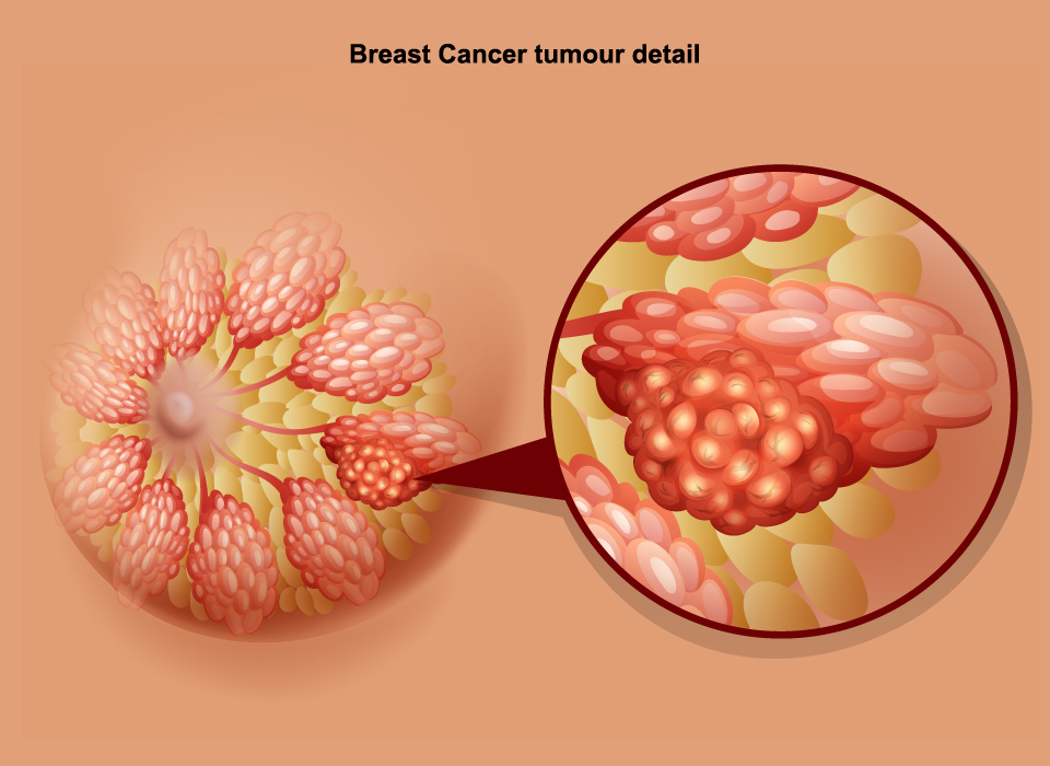 Breast Cancer Detail Large, Breast Cancer, Ashray Mylan 