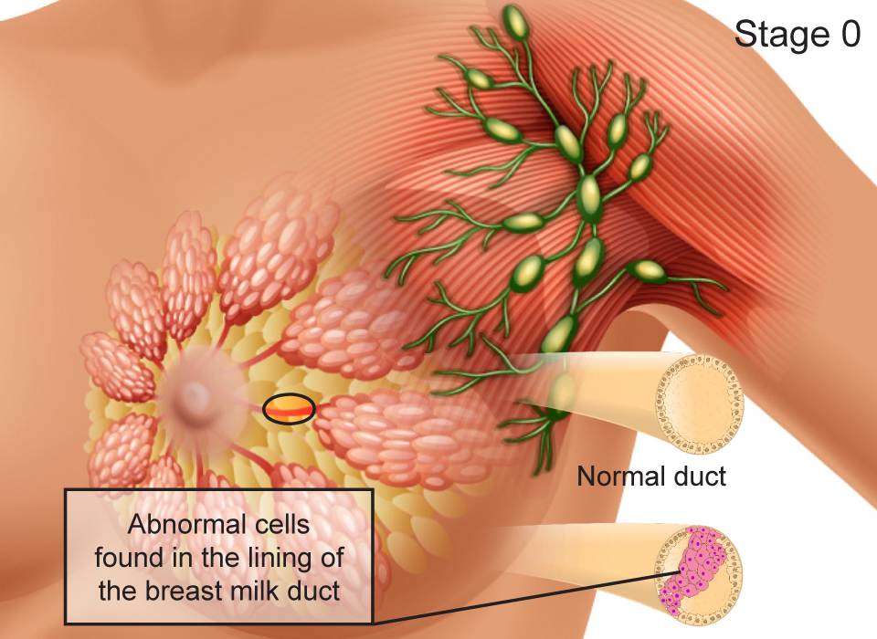 Breast Cancer Stages, Stage 0 (Situ): Abnormal cells found in the lining of the breast milk duct Large, Ashray Mylan 