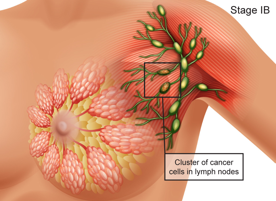 Breast Cancer Stages, Stage IB: Cluster of cancer cells in lymph nodes Large, Ashray Mylan 