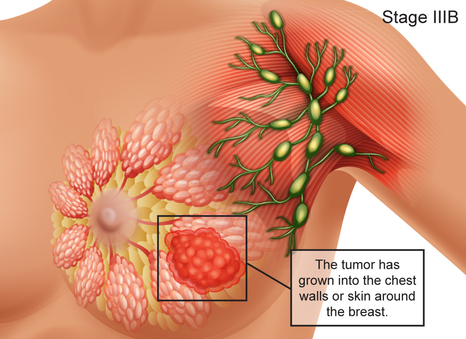 Breast Cancer Stages, Stage IIIB: The tumor has grown into the chest walls or skin around the breast Large, Ashray Mylan 