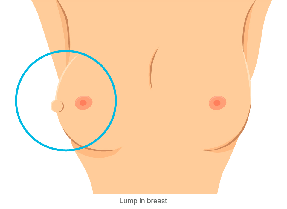 Breast Cancer Symptoms, Lump in Breast Large, Ashray Mylan 