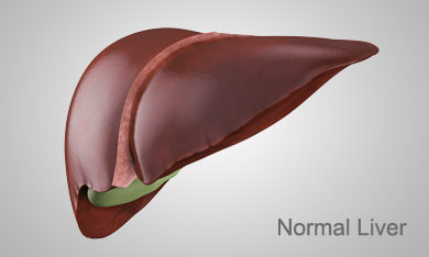 Stages of Liver disease: Normal, Hepatitis C, Ashray Mylan