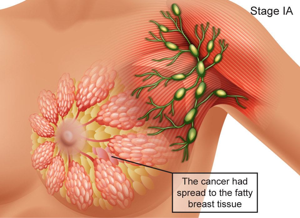 Breast Cancer Stages, Stage IA: The cancer had spread to the fatty breast tissue, Large, Ashray Mylan 