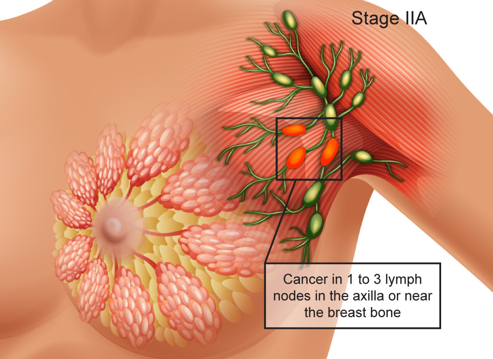 Breast Cancer Stages, Stage IIA: Cancer in 1 to 3 lymph nodes in the axilla or near the breast bone Large, Ashray Mylan