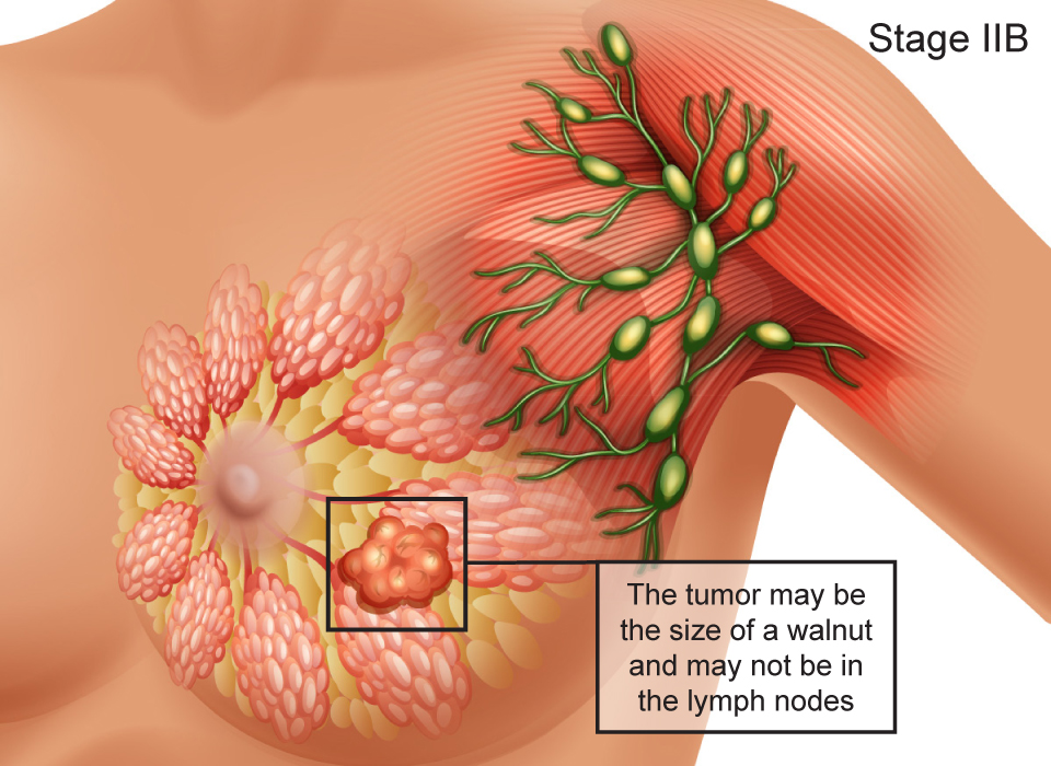 Breast Cancer Stages, Stage IIB: The tumor may be the size of a walnut and may not be in the lymph nodes Large, Ashray Mylan 