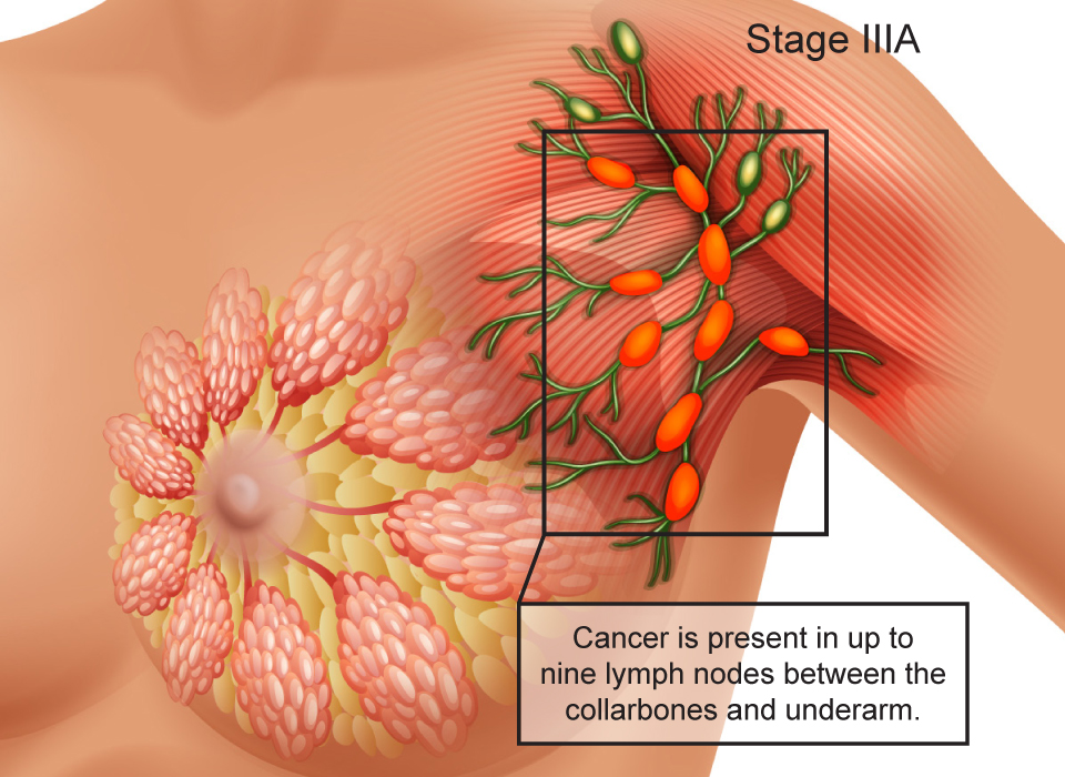 Breast Cancer Stages, Stage IIIA: Cancer is present in up to nine lymph nodes between the collarbones and underarm Large, Ashray Mylan 