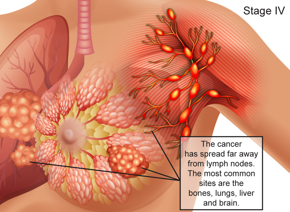 Breast Cancer Stages, Stage IV: The cancer has spread far away from lymph nodes. The most common sites are the  bones, lungs, liver and brain Large, Ashray Mylan 