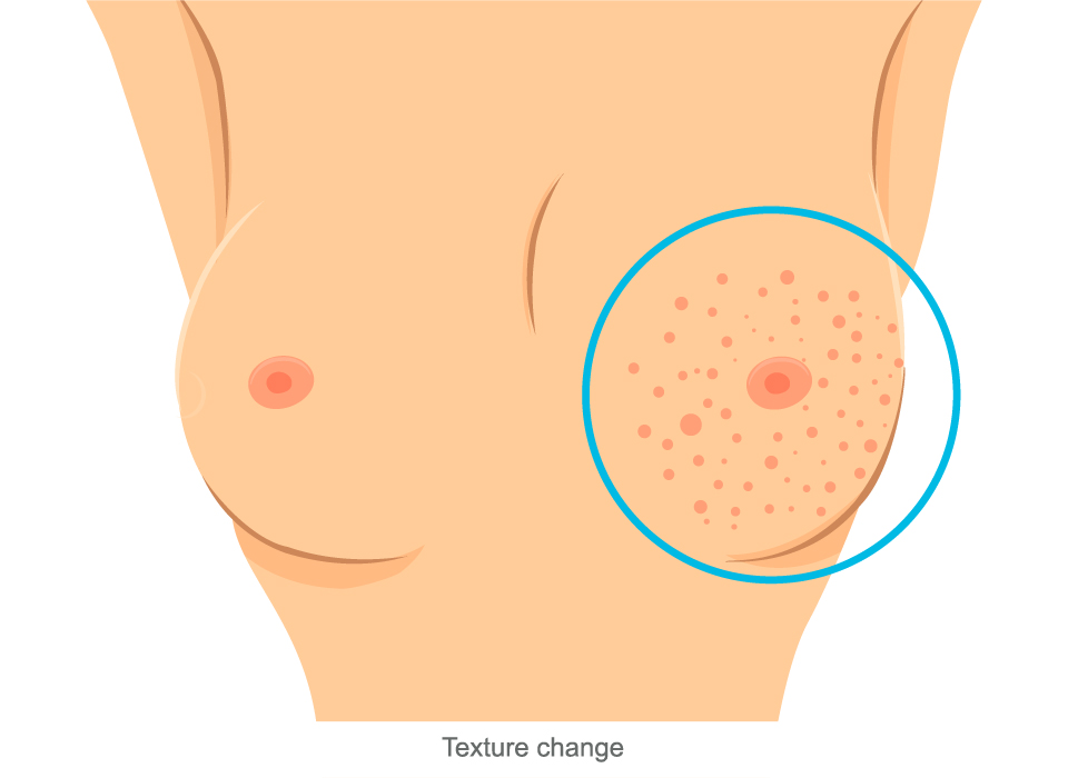 Breast Cancer Symptoms, Texture change Large, Ashray Mylan 