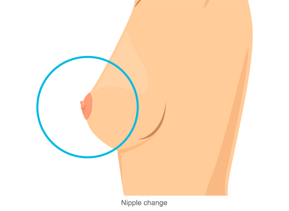 Breast Cancer Symptoms, Nipple change Large, Ashray Mylan 