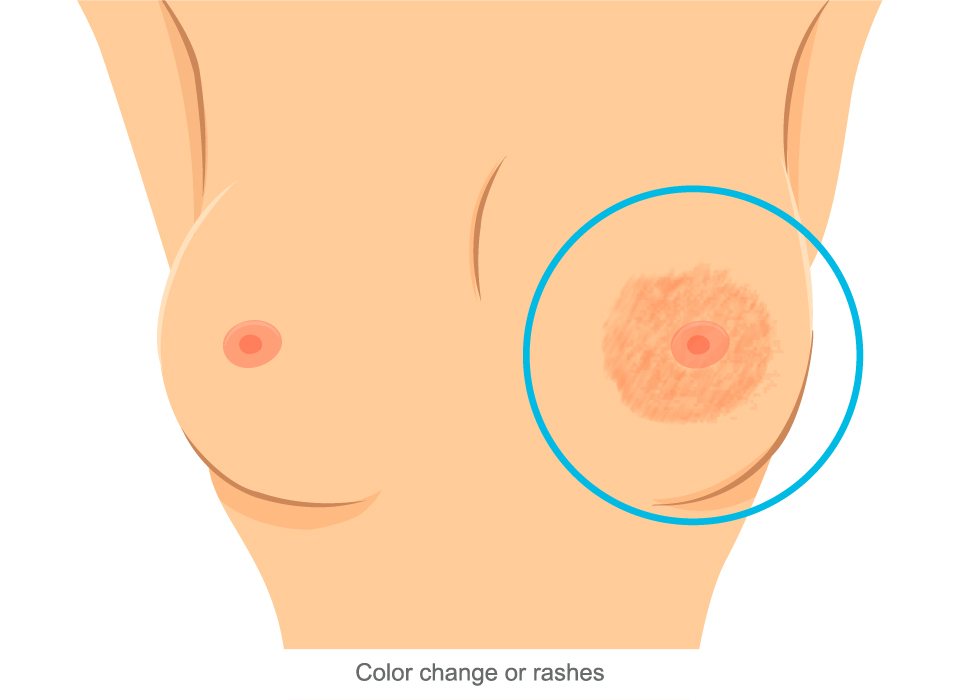 Breast Cancer Symptoms, Color change or rashes Large, Ashray Mylan 