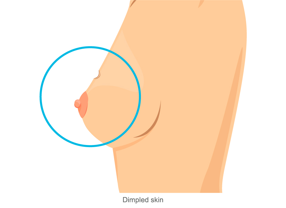 Breast Cancer Symptoms, Dimpled skin Large, Ashray Mylan 