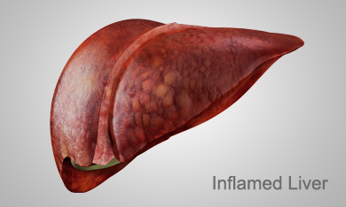 Stages of Liver disease: Inflamed, Hepatitis C, Ashray Mylan