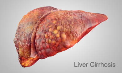 Stages of Liver disease: Cirrhosis, Hepatitis C, Ashray Mylan