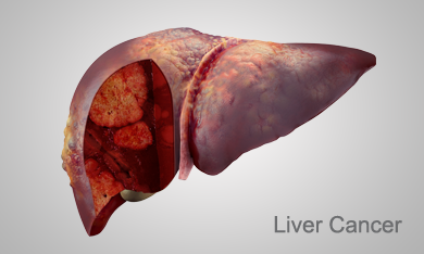 Stages of Liver disease: Liver Cancer, Hepatitis C, Ashray Mylan